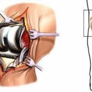 Consecințele leziunilor articulației genunchiului. Proteze și reabilitare