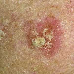 La ce boli patul pe piele este scalabil?