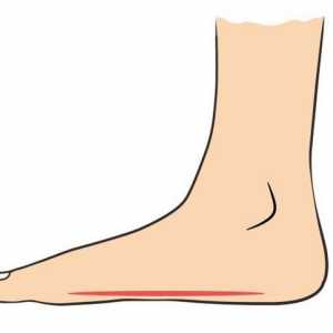 Picior longitudinal 2 picioare: diagnoză, trăsături de tratament