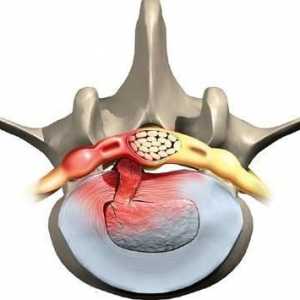 Protruziile coloanei vertebrale lombosacrale. Tratamentul proeminențelor regiunii lombare