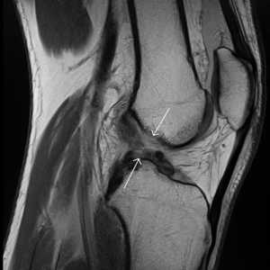 Ruptura ligamentului cruciat anterior: de ce se întâmplă și cum să o eliminați?