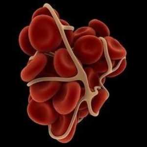Cele mai frecvente simptome ale cheagurilor de sânge