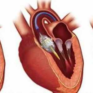 Supapă de inimă: intervenție chirurgicală pentru înlocuire și boli posibile