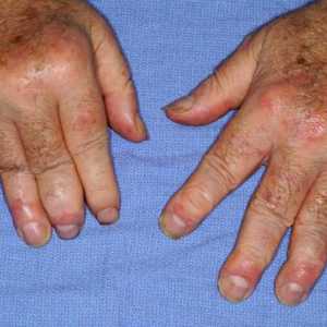 Simptomele și tratamentul artritei psoriazice