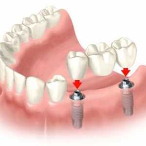 Cât costă un implant dentar în clinicile moderne?