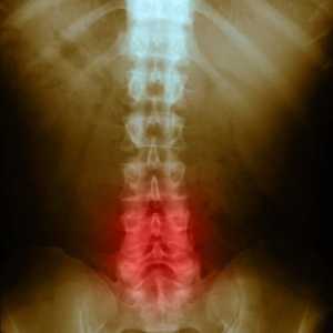 Spondilartroza coloanei vertebrale lombare: cauze, simptome și tratamentul bolii