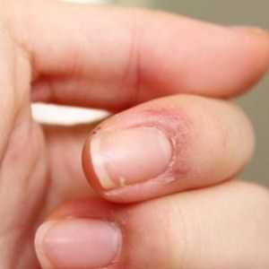 Piele fisurată pe degetele din apropierea unghiilor: cauzele și tratamentul. Cracked pielea de pe…
