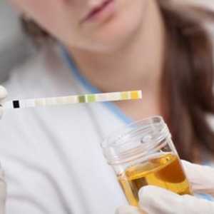 Urobilinogen în urină - ce înseamnă? Bilirubin și urobilinogen în analiza urinei