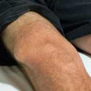 Genunchiul genunchiului: simptome de bază, tratament