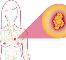 3 Grade de cancer mamar: speranța de viață. Breast Cancer Therapy