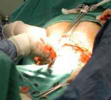 Operație abdominală. Conceptul de