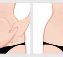 Abdominoplastia (plastic abdominal): indicații, contraindicații, descrierea procedurii, recenzii