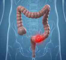 Sigmoid adenocarcinomul de colon: cauze, simptome, metode de tratament și predicții
