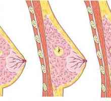 Adenomul mamar: simptome, metode de tratament