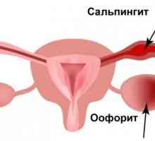 Adnexita: simptome și tratament la femei