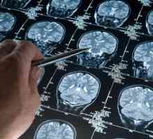 Boala Alzheimer: cauze și tratament, esență, simptome inițiale, dezvoltare, fotografii ale bolii…