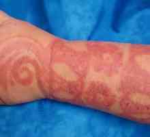 Alergia la henna: simptome și tratament. Henna pentru sprâncene