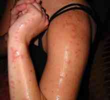 Alergia la mușcăturile de țânțari - simptome și tratament