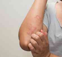 Alergii la nivelul pielii: cauze posibile, simptome și caracteristici de tratament