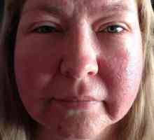 Alergia la fața locului la soare: fotografii, simptome, tratament
