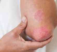 Alergie la tencuială: simptome și tratament