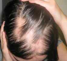 Alopecia este ceea ce este o boală? Cauze, simptome, tratamentul alopeciei