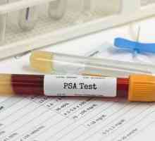 Analiza PSA cu prostatită: norma, trăsăturile de pregătire și recomandările