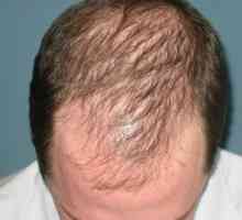 Alopecia androgena la femei și bărbați: cauze, tratament și consecințe