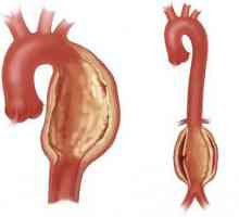 Anevrismul aortei inimii - ce este? Anevrismul aortei: cauze, simptome, tratament