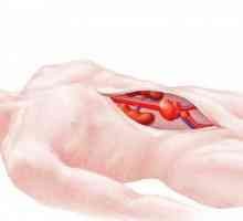 Anevrismul aortei abdominale: simptome, diagnostic, tratament
