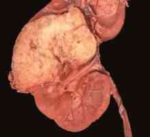 Angiomiolipomul rinichiului: este periculos pentru viață, cauze, simptome și tratament