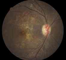 Angioscleroza retinei - ce este? Ce este periculos pentru hipertensiune?