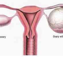 Formarea anemogenă în ovar. Ce este? Metode de tratament