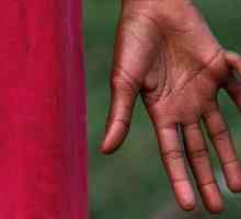 Anomalii ale dezvoltării membrelor: ce trebuie făcut dacă copilul are șase degete sau degete de la…