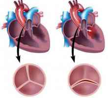 Supapă bivalve aortică: cauze, simptome, tratament