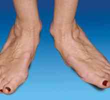 Artrita picioarelor: tratamentul și cauzele apariției
