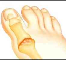 Artrita piciorului: soiuri, prevenire