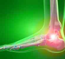 Osteoartrita gleznei: simptome și tratament. Cauzele și prevenirea artrozei gleznei