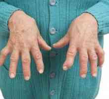 Артроз пальцев рук: симптомы и лечение