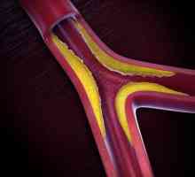 Ateroscleroza aortei inimii - ce este? Simptomele și tratamentul