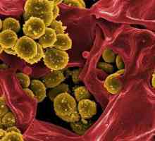Conjunctivită bacteriană: cauze, simptome și tratament