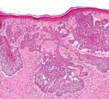 Cancerul celular al celulelor bazale: simptome, diagnostic, tratament