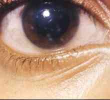 Belmo este opacitatea corneei ochiului. Cauze și tratament