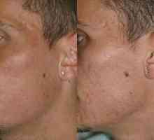 Eliminarea dureroasă și eficientă a cicatricilor prin laser