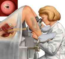 Biopsia de col uterin: ce este aceasta și de ce se efectuează această procedură?