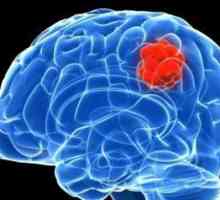 Blastomul creierului: simptome, prognostic