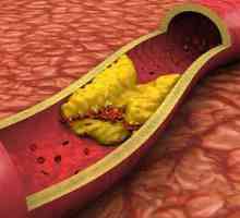 Plachetele din artera carotidă: tratament. Plachete de colesterol: cauze, simptome