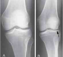 Boala genunchiului Schljatter la adolescent: cum să anesteziți și cum să tratați?