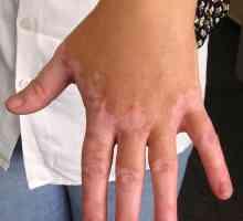 Boala vitiligo: cauze, simptome și tratamente
