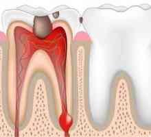 Este dureroasă îndepărtarea nervului din dinte? De ce un dinte are nevoie de un nerv? Cum să…